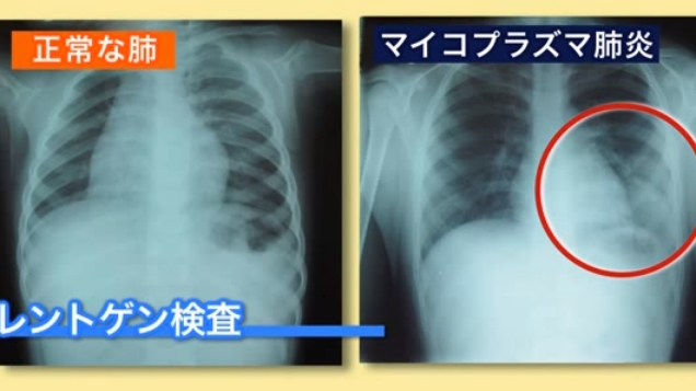 肺炎レントゲン写真の特徴は 症例画像で影の見方を解説